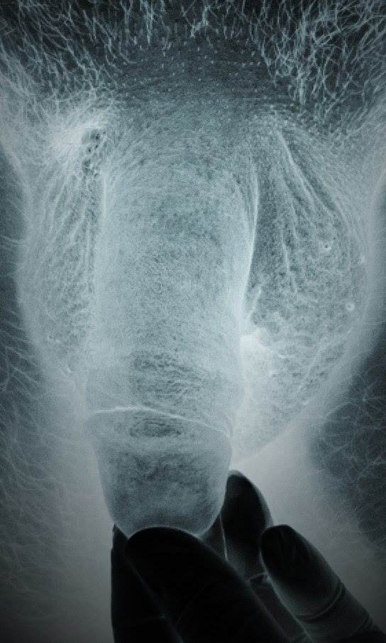 Stylized X-ray-style medical photograph two weeks after penile augmentation with 10 cc of Juvéderm Voluma