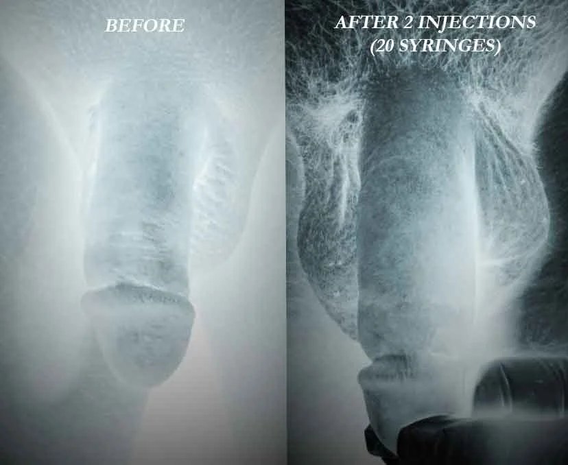 Side-by-side stylized X-ray-style medical photographs: before, and after two injection sessions totalling 20 syringes of Juvéderm Voluma