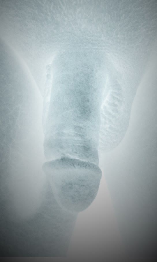 Stylized X-ray-style medical photograph before non-surgical penile augmentation at Neoderma Anaheim